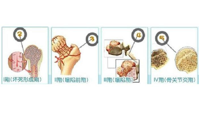 股骨头坏死的分期